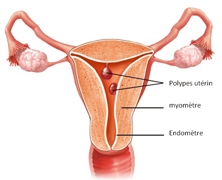 polype uterin